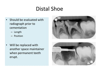 Distal Shoe
• Should be evaluated with
radiograph prior to
cementation
– Length
– Position
• Will be replaced with
another space maintainer
when permanent teeth
erupt.
 