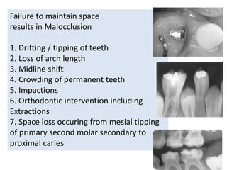 Failure to maintain space
results in Malocclusion
1. Drifting / tipping of teeth
2. Loss of arch length
3. Midline shift
4. Crowding of permanent teeth
5. Impactions
6. Orthodontic intervention including
Extractions
7. Space loss occuring from mesial tipping
of primary second molar secondary to
proximal caries
 