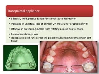 Transpalatal appliance
• Bilateral, fixed, passive & non-functional space maintainer
• Indicated in unilateral loss of primary 2nd molar after eruption of PFM
• Effective in preventing molars from rotating around palatal roots
• Prevents anchorage loss
• Transpalatal arch runs across the palatal vault avoiding contact with soft
tissue
 
