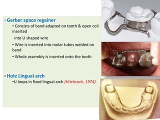 • Gerber space regainer
• Consists of band adapted on tooth & open coil
inserted
into U shaped wire
• Wire is inserted into molar tubes welded on
band
• Whole assembly is inserted onto the tooth
• Hotz Lingual arch
•U loops in fixed lingual arch (Hitchcock, 1974)
 