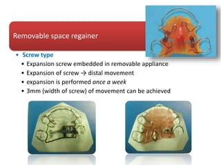Removable space regainer
• Screw type
• Expansion screw embedded in removable appliance
• Expansion of screw → distal movement
• expansion is performed once a week
• 3mm (width of screw) of movement can be achieved
 