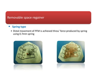 Removable space regainer
• Spring type
• Distal movement of PFM is achieved throu’ force produced by spring
using 0.7mm spring
 