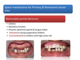 Removable partial dentures
• Esthetic
• Maintains function
• Prevents abnormal speech & tongue habits
• Indicated in young cooperative children
• Contraindicated in children with high caries risk
Space maintenance for Primary & Permanent incisor
area
 