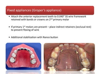 Fixed appliances (Groper’s appliance)
• Attach the anterior replacement teeth to 0.040” SS wire framework
retained with bands or crowns on 2nd primary molar
• If primary 1st molars are present – place indirect retainers (occlusal rest)
to prevent flexing of wire
• Additional stabilization with Nance button
 