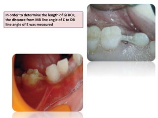 In order to determine the length of GFRCR,
the distance from MB line angle of C to DB
line angle of E was measured
 