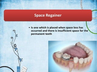 Space Regainer
• Is one which is placed when space loss has
occurred and there is insufficient space for the
permanent teeth
 