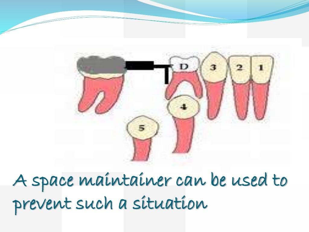 Space maintainers