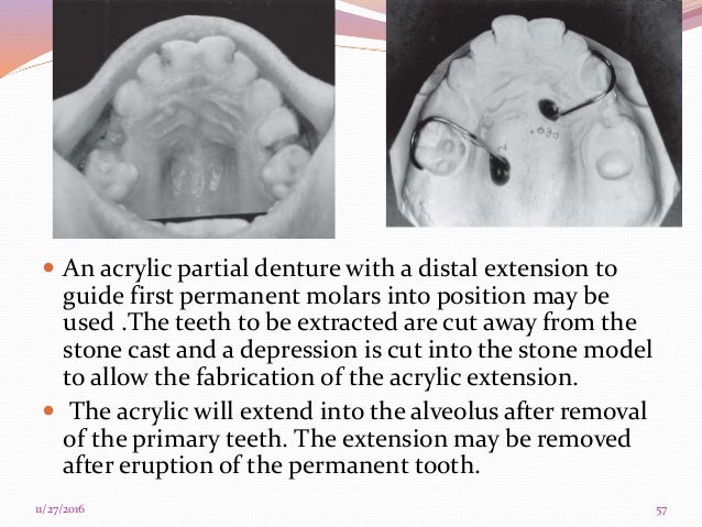 Distal Shoe Appliance 3ddesignhubs