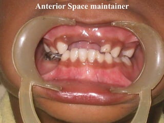 Anterior Space maintainer
 