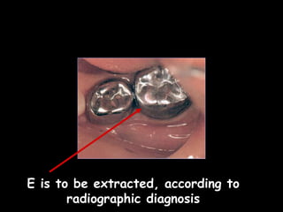 E is to be extracted, according to
radiographic diagnosis
 