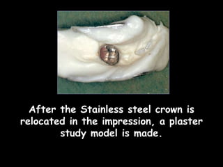After the Stainless steel crown is
relocated in the impression, a plaster
study model is made.
 