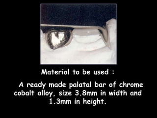 Material to be used :
A ready made palatal bar of chrome
cobalt alloy, size 3.8mm in width and
1.3mm in height.
 