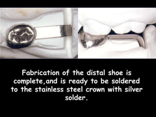 Fabrication of the distal shoe is
complete,and is ready to be soldered
to the stainless steel crown with silver
solder.
 
