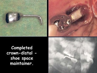 Completed
crown-distal -
shoe space
maintainer.
 