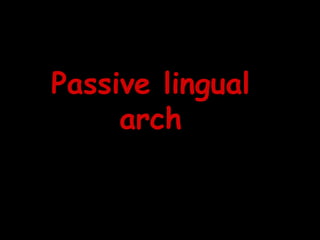 Passive lingual
arch
 