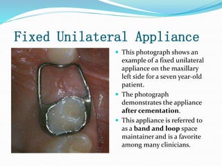 Fixed Unilateral Appliance
 This photograph shows an
example of a fixed unilateral
appliance on the maxillary
left side for a seven year-old
patient.
 The photograph
demonstrates the appliance
after cementation.
 This appliance is referred to
as a band and loop space
maintainer and is a favorite
among many clinicians.
 