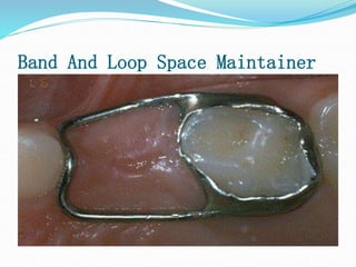Band And Loop Space Maintainer
 