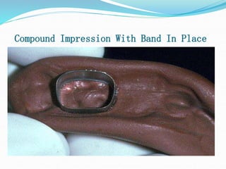 Compound Impression With Band In Place
 