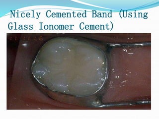 Nicely Cemented Band (Using
Glass Ionomer Cement)
 