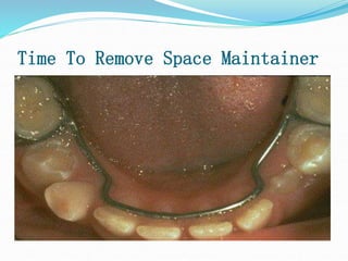 Time To Remove Space Maintainer
 