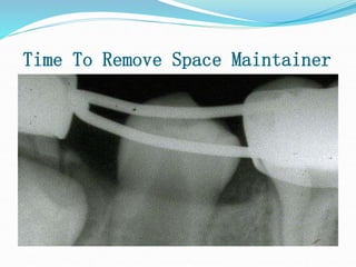 Time To Remove Space Maintainer
 