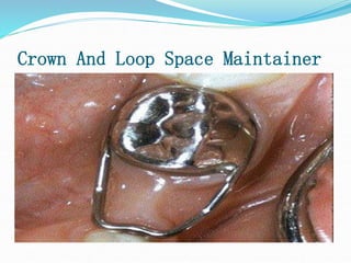 Crown And Loop Space Maintainer
 
