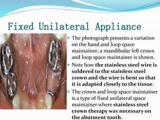 Fixed Unilateral Appliance
 The photograph presents a variation
on the band and loop space
maintainer; a mandibular left crown
and loop space maintainer is shown.
 Note how the stainless steel wire is
soldered to the stainless steel
crown and the wire is bent so that
it is adapted closely to the tissue.
 The crown and loop space maintainer
is a type of fixed unilateral space
maintainer where stainless steel
crown therapy was necessary on
the abutment tooth.
 