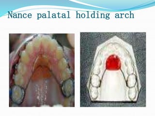 Nance palatal holding arch
 