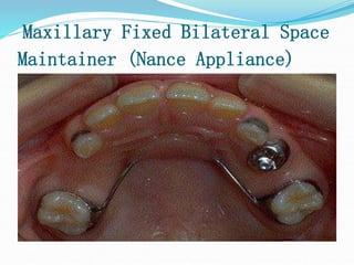 Maxillary Fixed Bilateral Space
Maintainer (Nance Appliance)
 