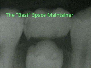 The "Best" Space Maintainer
 