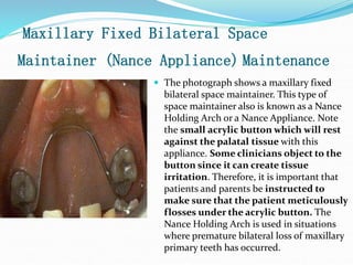 Maxillary Fixed Bilateral Space
Maintainer (Nance Appliance) Maintenance
 The photograph shows a maxillary fixed
bilateral space maintainer. This type of
space maintainer also is known as a Nance
Holding Arch or a Nance Appliance. Note
the small acrylic button which will rest
against the palatal tissue with this
appliance. Some clinicians object to the
button since it can create tissue
irritation. Therefore, it is important that
patients and parents be instructed to
make sure that the patient meticulously
flosses under the acrylic button. The
Nance Holding Arch is used in situations
where premature bilateral loss of maxillary
primary teeth has occurred.
 