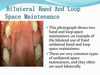 Bilateral Band And Loop
Space Maintenance
 This photograph shows two
band and loop space
maintainers, an example of
the bilateral use of fixed
unilateral band and loop
space maintainers.
 These are very common types
of unilateral space
maintainers, and they often
are used bilaterally.
 