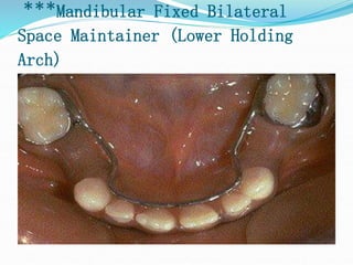 ***Mandibular Fixed Bilateral
Space Maintainer (Lower Holding
Arch)
 