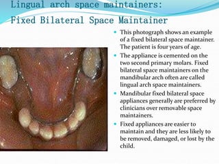 Lingual arch space maintainers:
Fixed Bilateral Space Maintainer
 This photograph shows an example
of a fixed bilateral space maintainer.
The patient is four years of age.
 The appliance is cemented on the
two second primary molars. Fixed
bilateral space maintainers on the
mandibular arch often are called
lingual arch space maintainers.
 Mandibular fixed bilateral space
appliances generally are preferred by
clinicians over removable space
maintainers.
 Fixed appliances are easier to
maintain and they are less likely to
be removed, damaged, or lost by the
child.
 