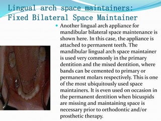 Lingual arch space maintainers:
Fixed Bilateral Space Maintainer
 Another lingual arch appliance for
mandibular bilateral space maintenance is
shown here. In this case, the appliance is
attached to permanent teeth. The
mandibular lingual arch space maintainer
is used very commonly in the primary
dentition and the mixed dentition, where
bands can be cemented to primary or
permanent molars respectively. This is one
of the most ubiquitously used space
maintainers. It is even used on occasion in
the permanent dentition when bicuspids
are missing and maintaining space is
necessary prior to orthodontic and/or
prosthetic therapy.
 