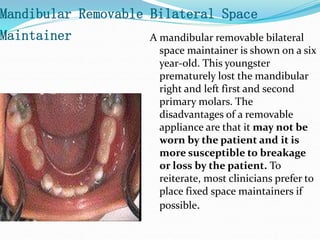Mandibular Removable Bilateral Space
Maintainer A mandibular removable bilateral
space maintainer is shown on a six
year-old. This youngster
prematurely lost the mandibular
right and left first and second
primary molars. The
disadvantages of a removable
appliance are that it may not be
worn by the patient and it is
more susceptible to breakage
or loss by the patient. To
reiterate, most clinicians prefer to
place fixed space maintainers if
possible.
 