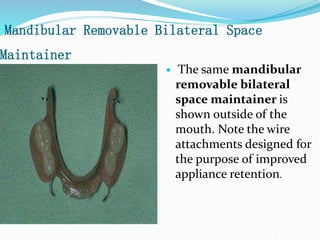 Mandibular Removable Bilateral Space
Maintainer
 The same mandibular
removable bilateral
space maintainer is
shown outside of the
mouth. Note the wire
attachments designed for
the purpose of improved
appliance retention.
 