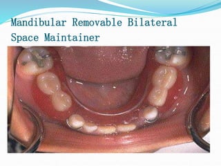 Mandibular Removable Bilateral
Space Maintainer
 