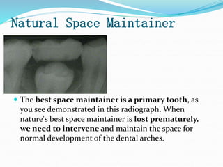 Natural Space Maintainer
 The best space maintainer is a primary tooth, as
you see demonstrated in this radiograph. When
nature's best space maintainer is lost prematurely,
we need to intervene and maintain the space for
normal development of the dental arches.
 