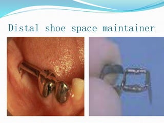 Distal shoe space maintainer
 
