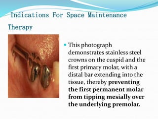 Indications For Space Maintenance
Therapy
 This photograph
demonstrates stainless steel
crowns on the cuspid and the
first primary molar, with a
distal bar extending into the
tissue, thereby preventing
the first permanent molar
from tipping mesially over
the underlying premolar.
 
