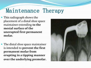Maintenance Therapy
 This radiograph shows the
placement of a distal shoe space
maintainer extending to the
mesial surface of the
unerupted first permanent
molar.
 The distal shoe space maintainer
is intended to prevent the first
permanent molar from
erupting in a tipping manner
over the underlying premolar.
 