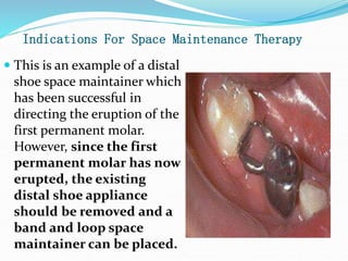 Indications For Space Maintenance Therapy
 This is an example of a distal
shoe space maintainer which
has been successful in
directing the eruption of the
first permanent molar.
However, since the first
permanent molar has now
erupted, the existing
distal shoe appliance
should be removed and a
band and loop space
maintainer can be placed.
 