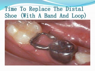 Time To Replace The Distal
Shoe (With A Band And Loop)
 