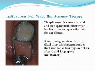 Indications For Space Maintenance Therapy
 This photograph shows the band
and loop space maintainer which
has been used to replace the distal
shoe appliance.
 It is advantageous to replace the
distal shoe, which extends under
the tissue and is less hygienic than
a band and loop space
maintainer.
 