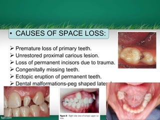 • CAUSES OF SPACE LOSS:
 Premature loss of primary teeth.
 Unrestored proximal carious lesion.
 Loss of permanent incisors due to trauma.
 Congenitally missing teeth.
 Ectopic eruption of permanent teeth.
 Dental malformations-peg shaped laterals.
 