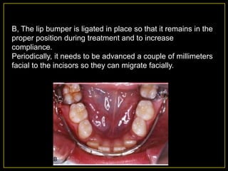 Space Regaining in Orthodontics | PPTX