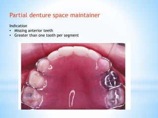 Partial denture space maintainer
Indication
• Missing anterior teeth
• Greater than one tooth per segment
 