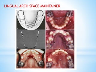 LINGUAL ARCH SPACE MAINTAINER
 