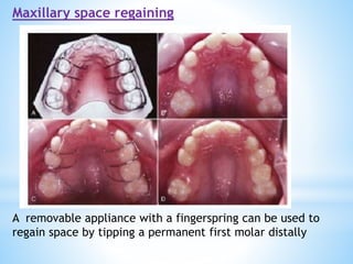 Maxillary space regaining
A removable appliance with a fingerspring can be used to
regain space by tipping a permanent first molar distally
 